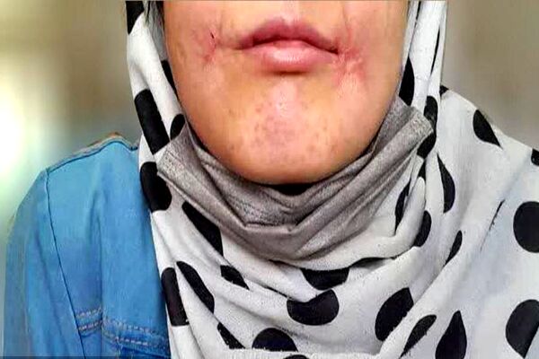 مرد معتاد لب‌های زن ۱۸ ساله‌اش را دوخت| اظهارات تکان‌دهنده فائزه در کلانتری خواجه‌ربیع مشهد